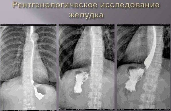Рентген кишечника. показания, противопоказания, подготовка и методика проведения. что показывает эта процедура в норме?
