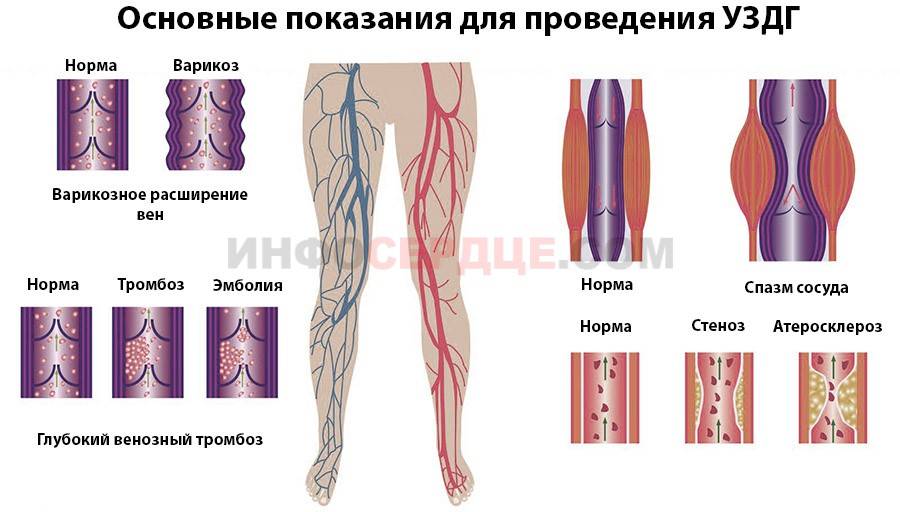 Сосуды вен нижних конечностей. УЗИ артерии и вены нижних конечностей. Доплерографическое исследование вен нижних конечностей. УЗДГ сосудов (артерий и вен) нижних конечностей. Схема вен нижних конечностей для УЗДГ.