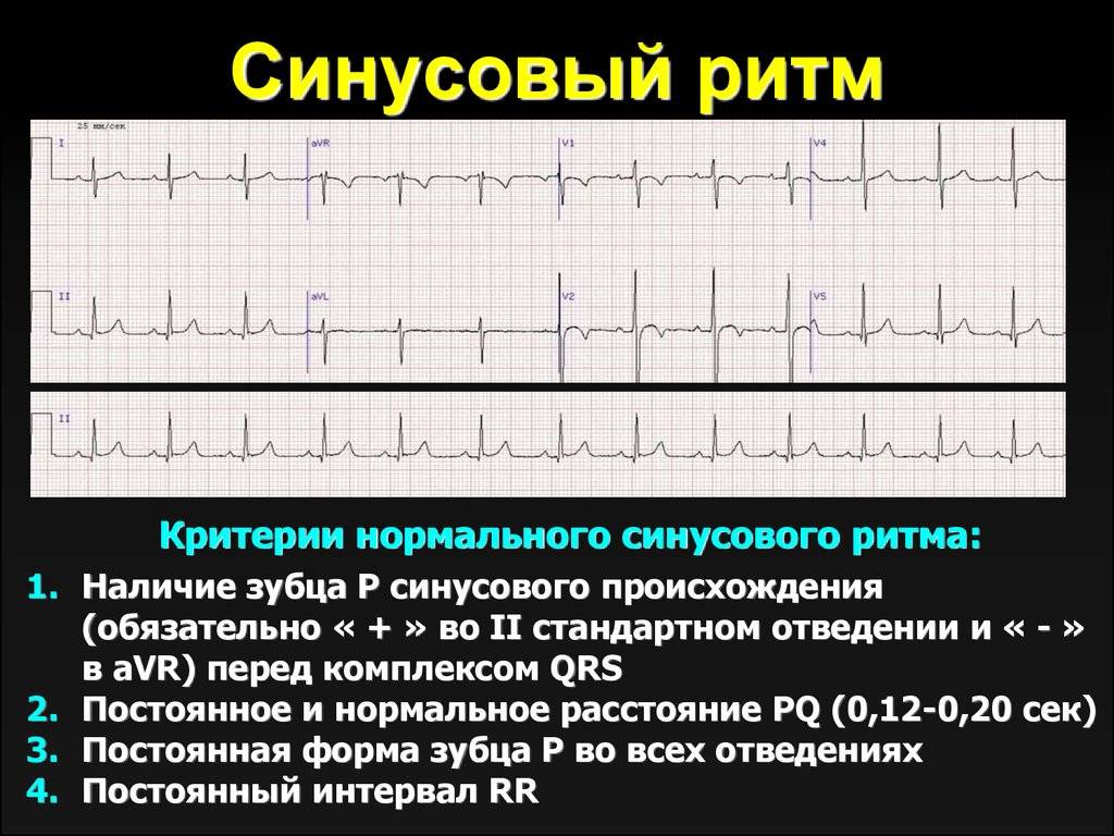 Синусовый ритм на экг: что это означает, признаки на кардиограмме сердца