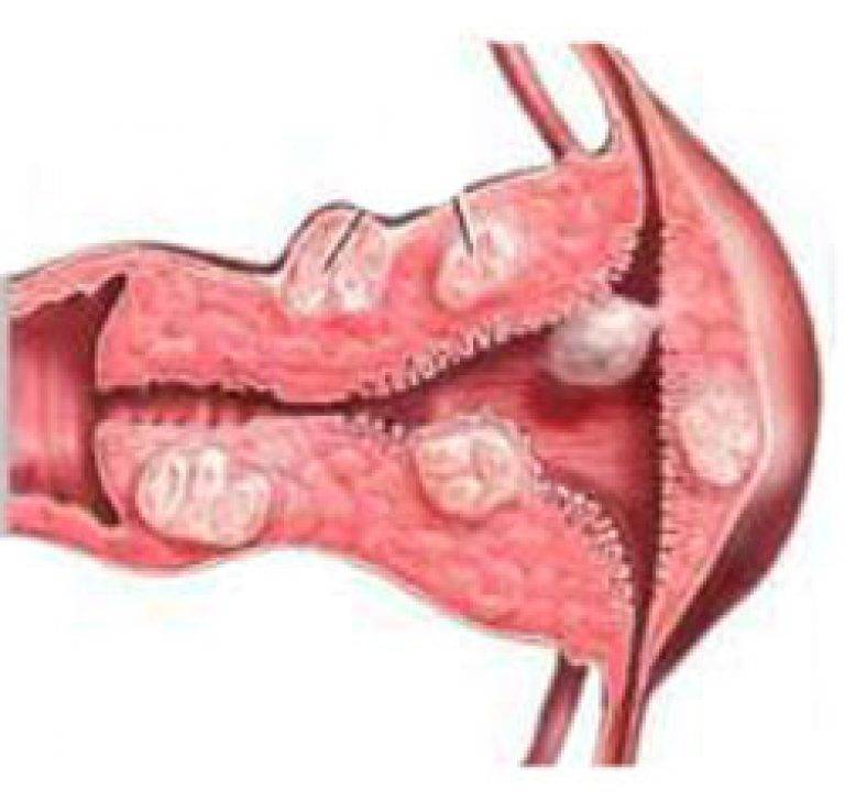 Железисто-фиброзный полип эндометрия: симптомы, лечение после удаления