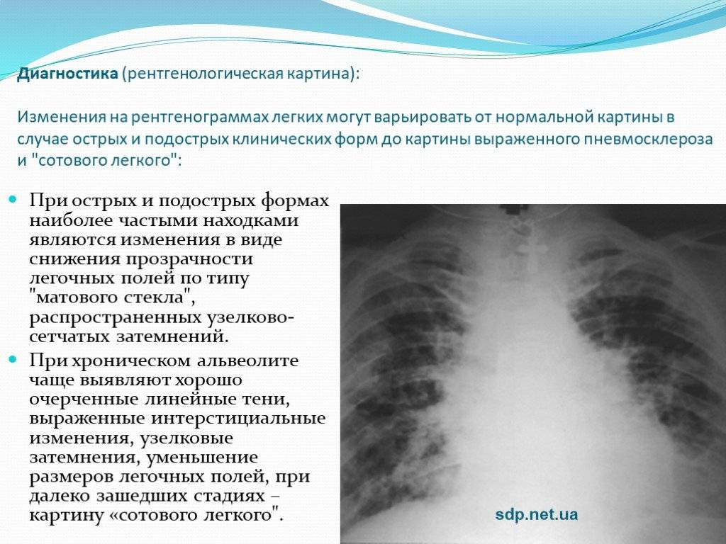 Причины изменений в легких. Пневмосклероз рентген описание. Рентген картина фиброза легких. Описание фиброза на рентгене. Рентген признаки пневмофиброза.