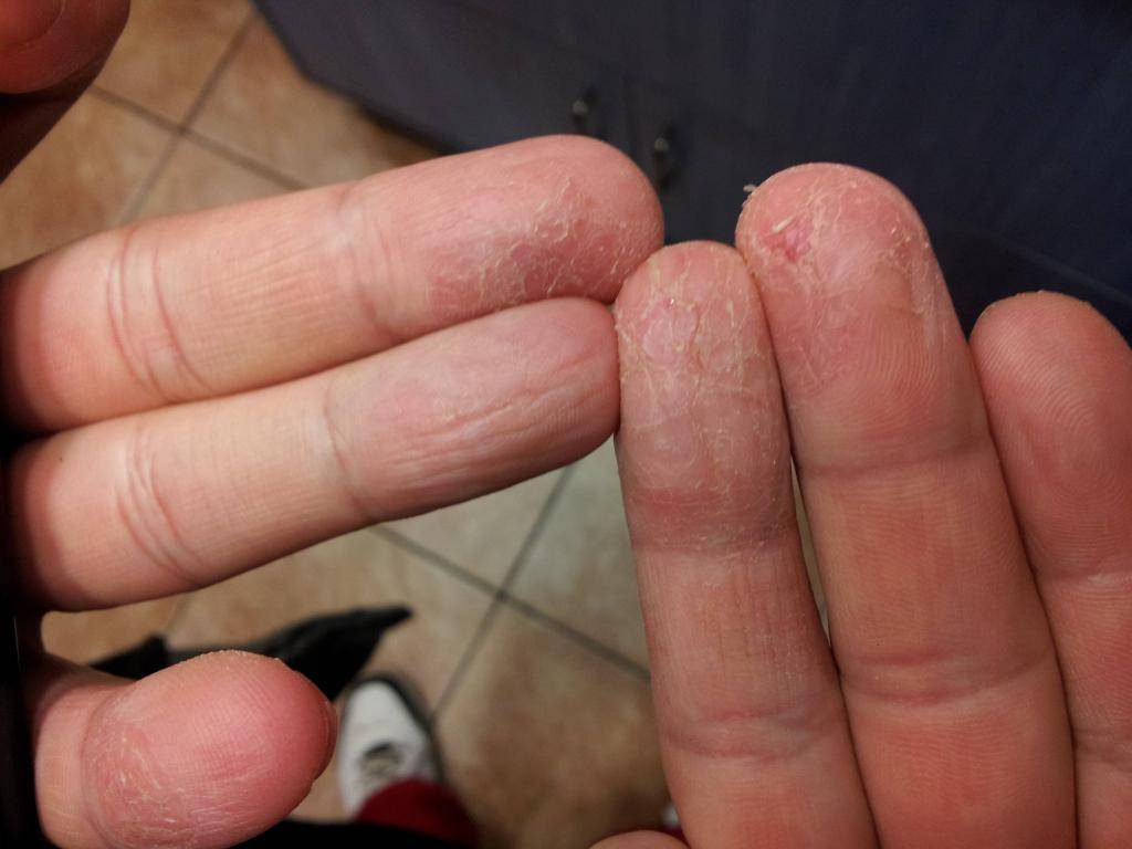 У ребенка трескается кожа на пальцах рук: причины и лечение | справочник ла-кри