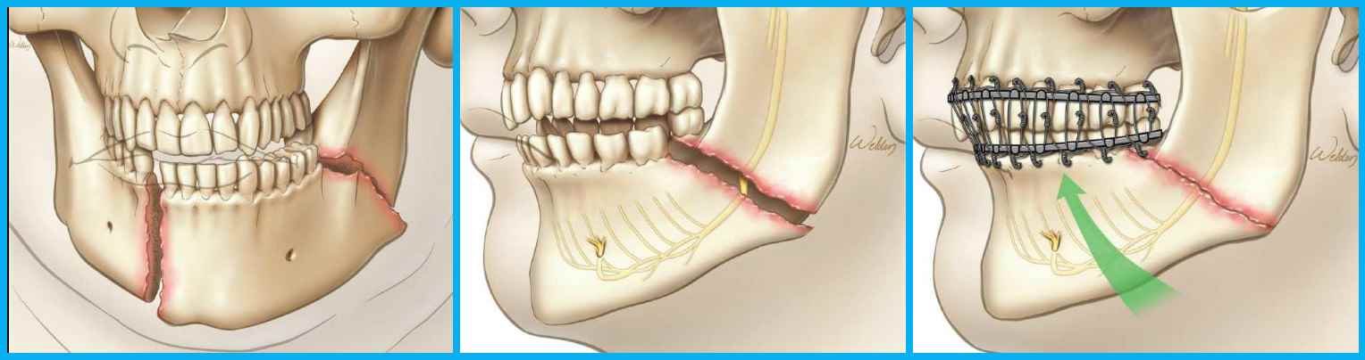 Хрустит челюсть – причины звуков, лечение и советы экспертов по устранению хруста