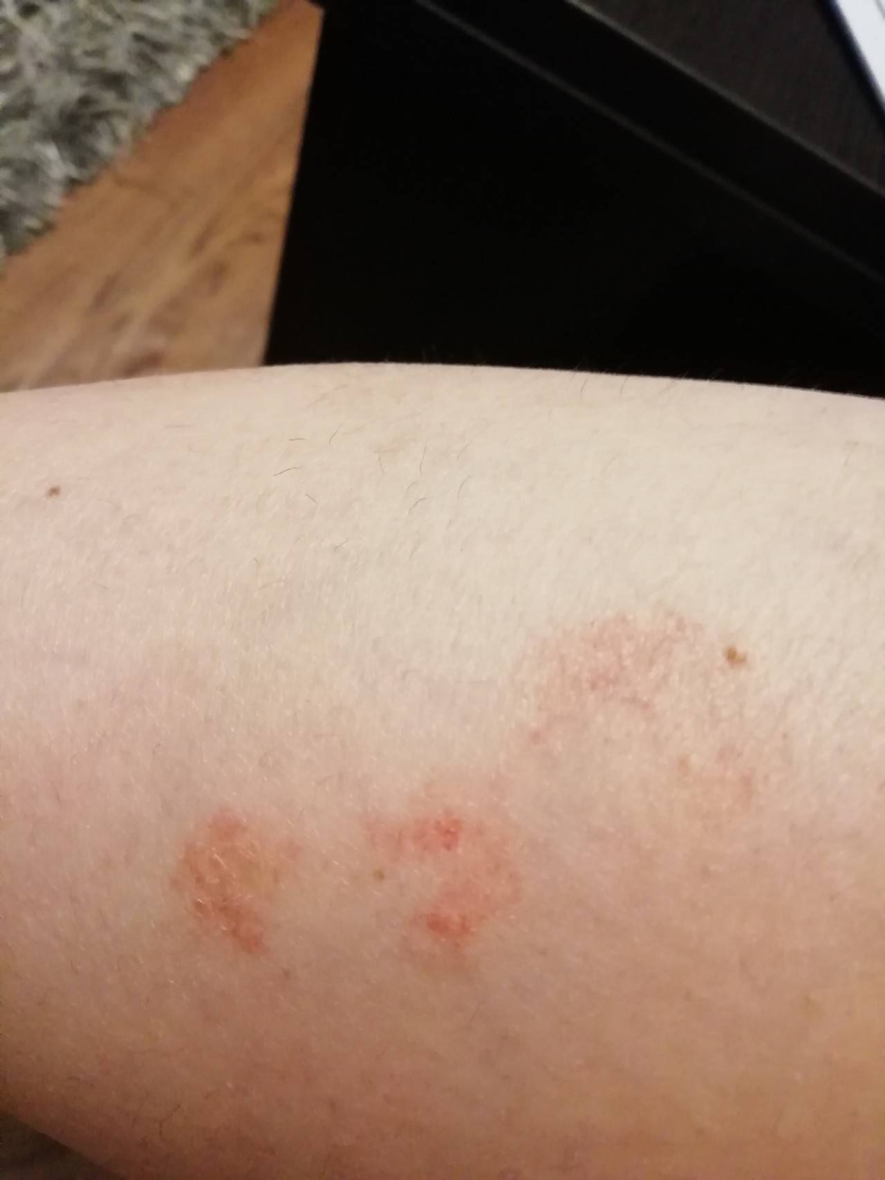 Аллергия на коже, красные пятна чешутся: лечение