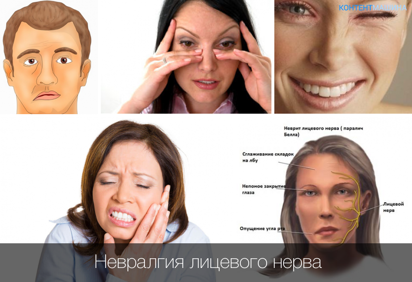 Воспаление лицевого нерва: симптомы и лечение в домашних условиях народными средствами
