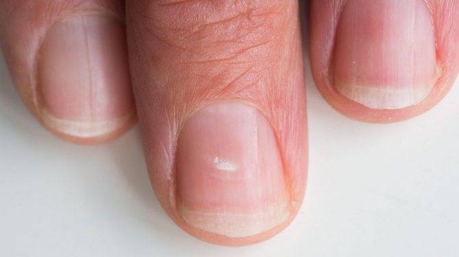 Белые пятна на ногтях: причины появления, способы лечения