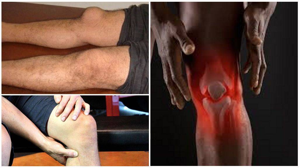 Препателлярный бурсит коленного сустава: лечение
