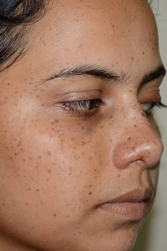 Пигментные пятна на лице причины и лечение у женщин 