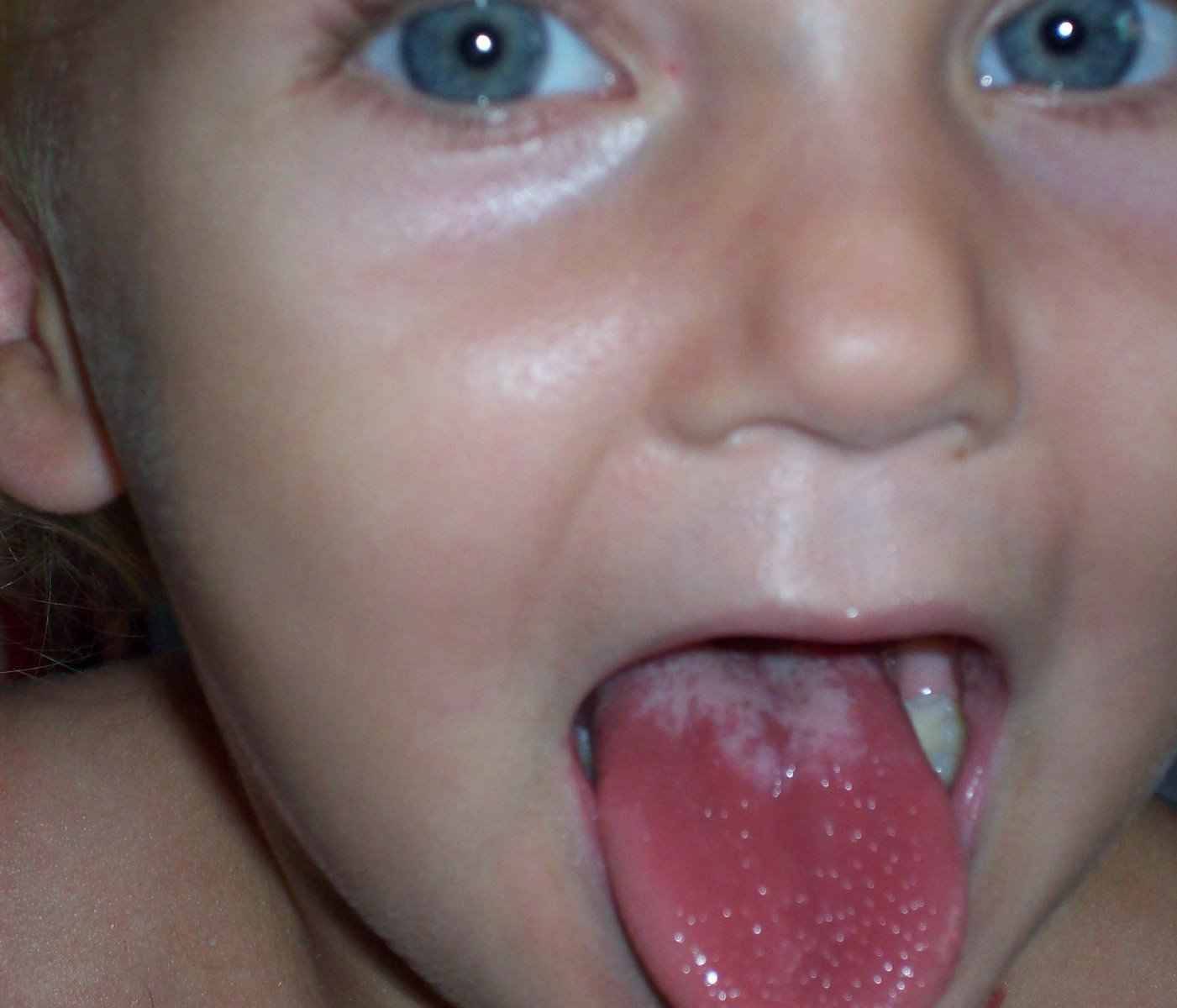 Скарлатина у детей (17 фото): симптомы и лечение, признаки, начальная стадия, что это, инкубационный период
