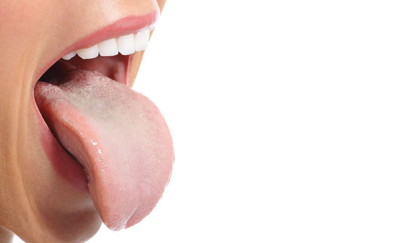 Что представляет собой кандидоз полости рта: лечение поражённой ротовой полости, фото, профилактические меры