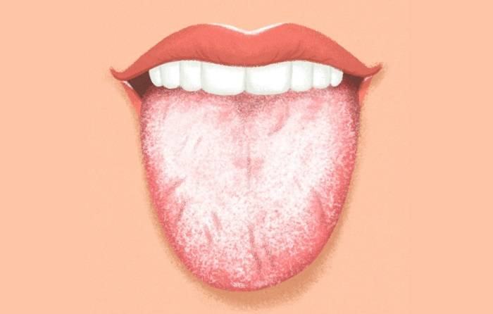 Сухость во рту и белый налет на языке - причины какой болезни?