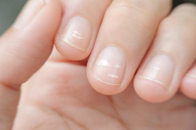 Белые пятна на ногтях. топ 25 причины, что означают. приметы, к чему белые пятнышки на ногтях