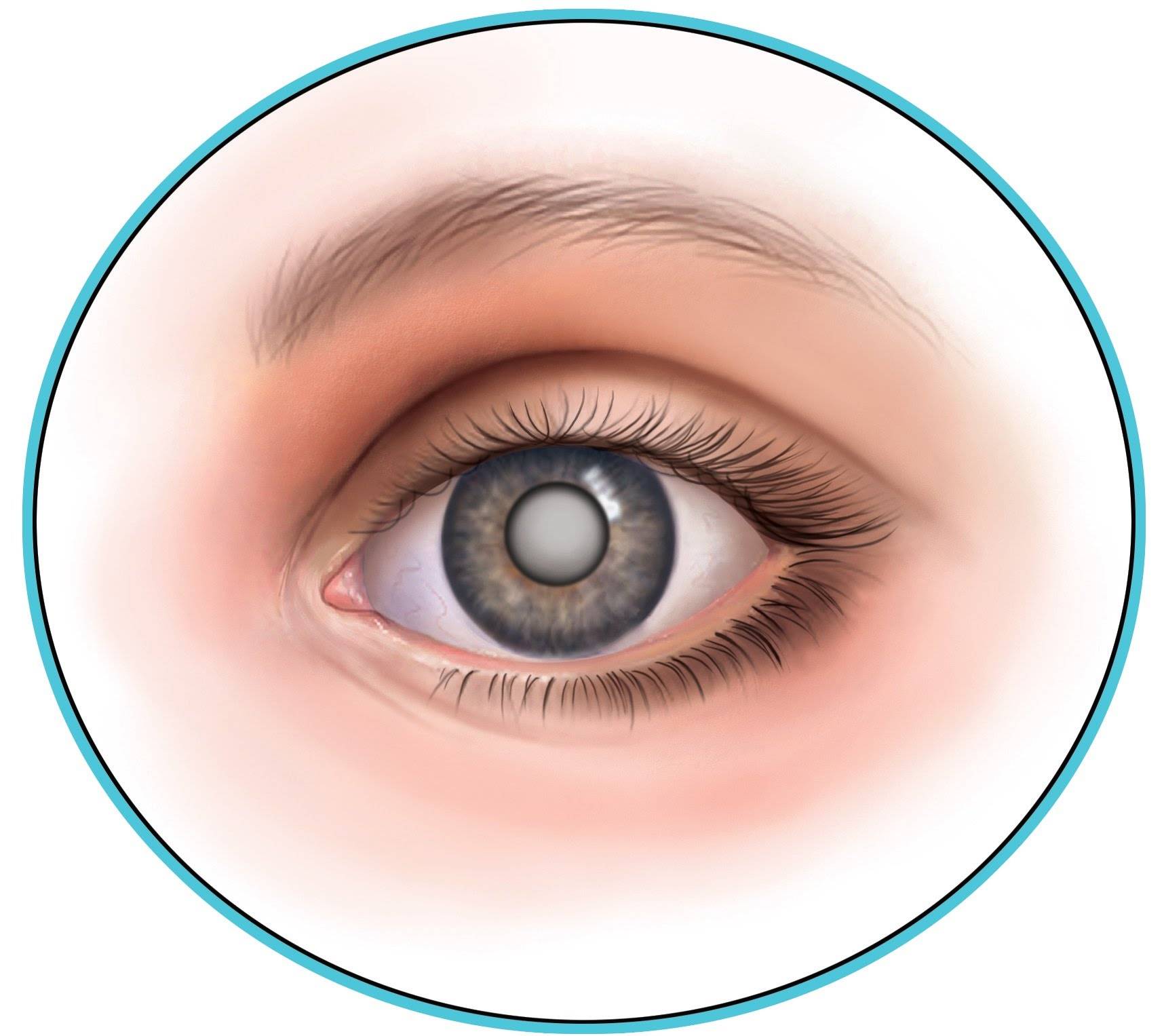 Катаракта глаза операция: противопоказания, подготовка, осложнения, как проходит операция, виды | офтальмология