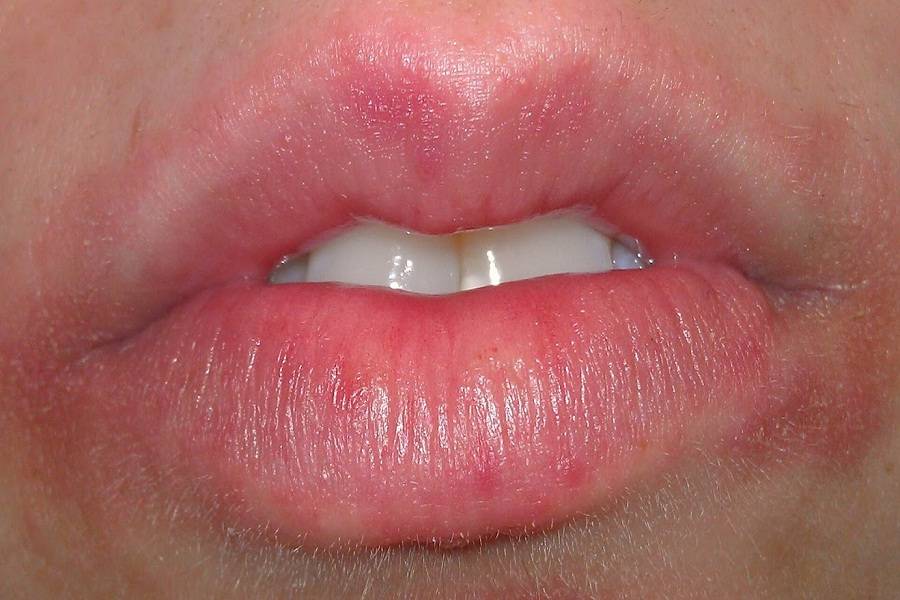 Заеды у детей в уголках рта: причины и эффективные методы лечения
