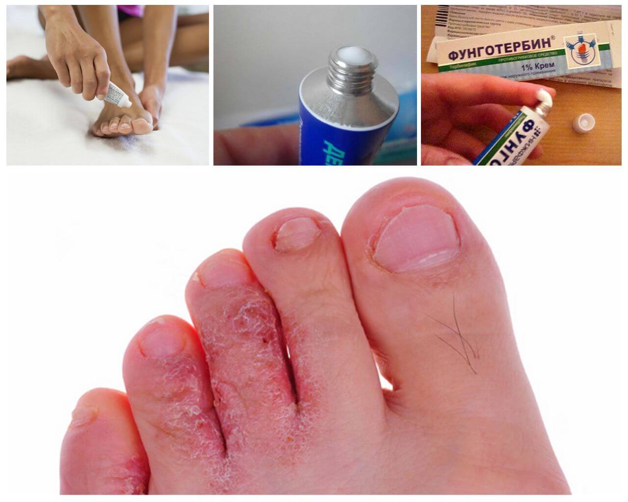 Трещины между пальцами ног: причины, лечение и профилактика