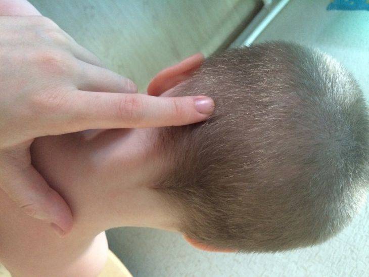 Растет затылок. Шишки на волосистой части головы. Шишечка на затылке у ребенка.