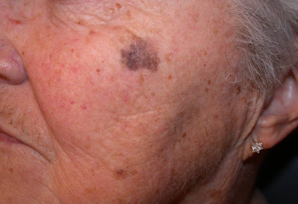 Старческие пятна на коже: причины возникновения и виды возрастной пигментации, лечение народными средствами