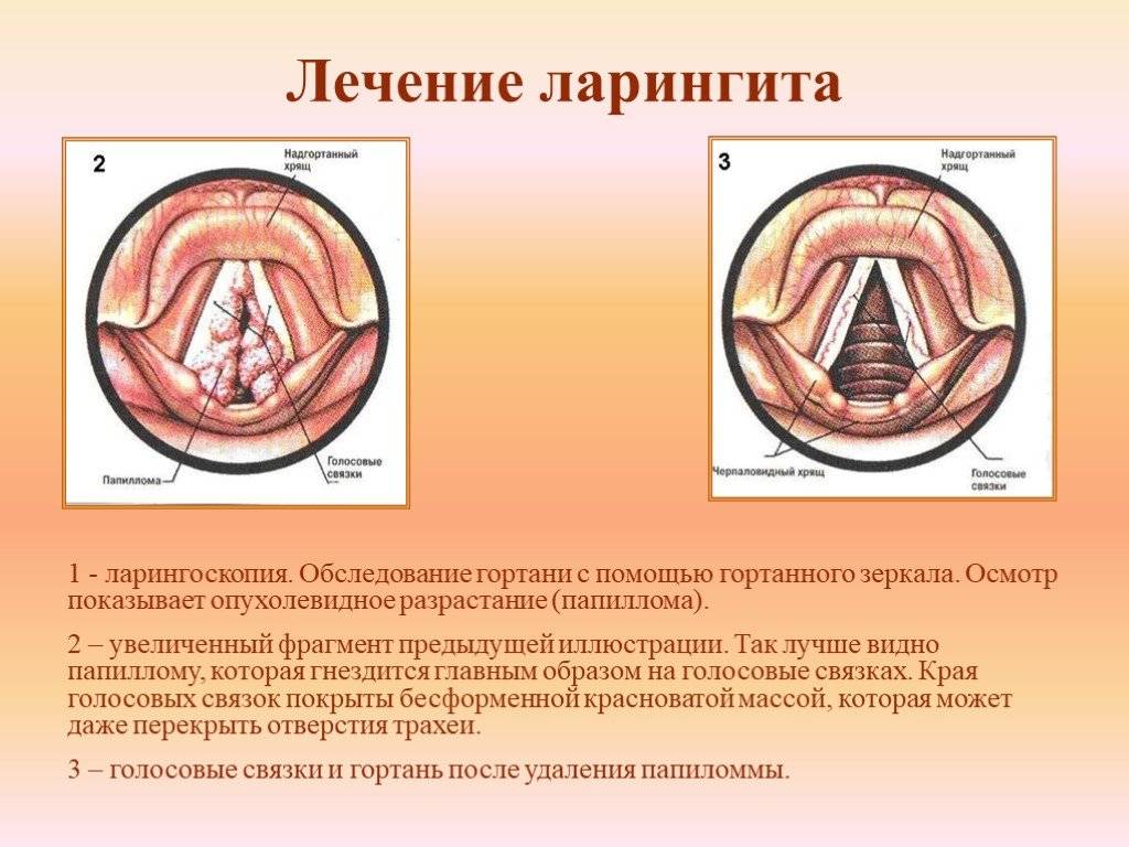 Схема лечения ларингита у взрослых