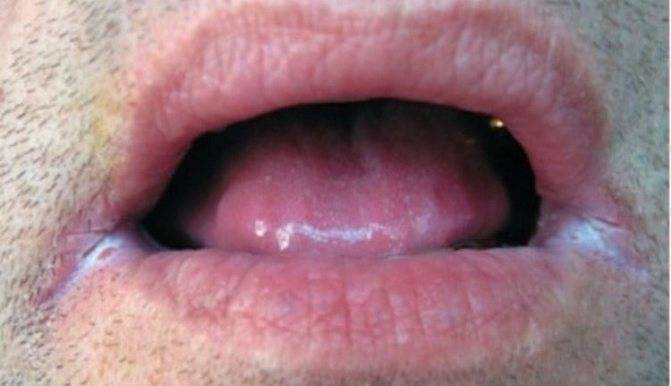 Заеды на губах: причины, лечение трещин в уголках рта
