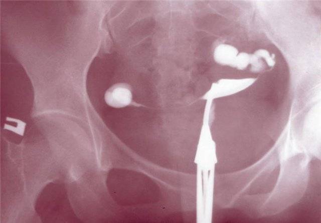 Воспаление маточных труб: что это такое. причины, симптомы и лечение воспаления маточных труб |
            эко-блог