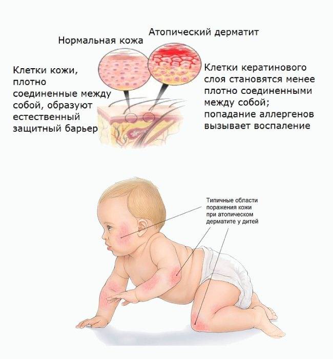 Грибковый пеленочный дерматит у ребенка: фото, симптомы и лечение | fr-dc.ru