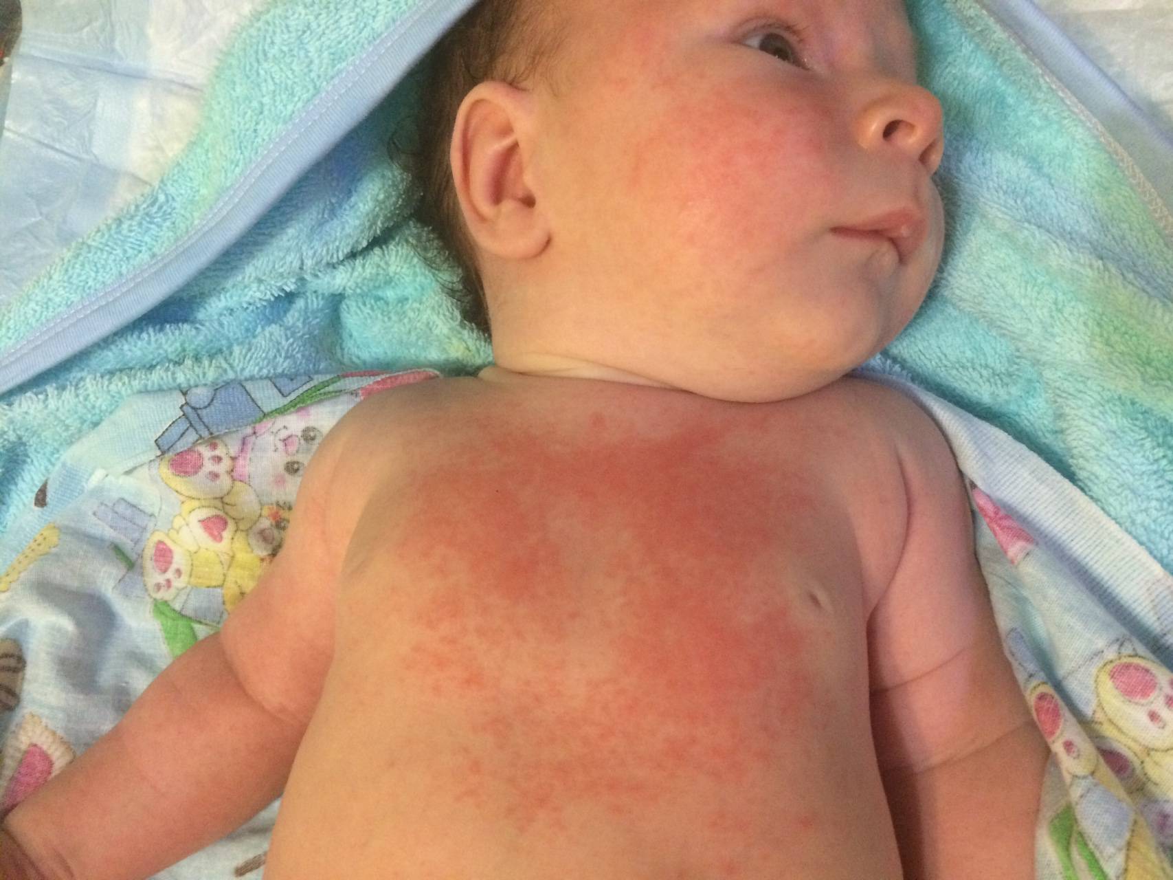 Как выглядит пеленочный дерматит: фото у детей, на попе у ребенка, памперсный дерматит