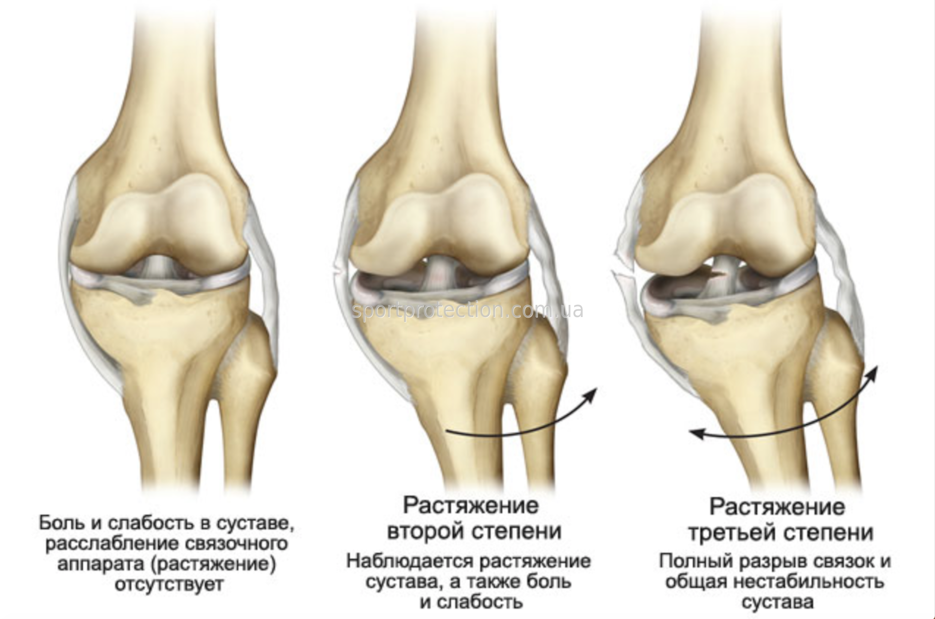 Ушиб повреждение связок колена. Диагностика повреждений боковых связок коленного сустава. Степени повреждения коленного сустава. Степени разрыва боковой связки коленного сустава.