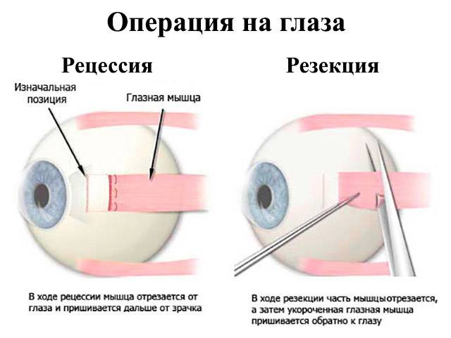 Можно пить после операции на глаза. Исправление оперированного косоглазия. Операция по устранению косоглазия у детей. Склеропластика глаз после операции. Операции при косоглазии.