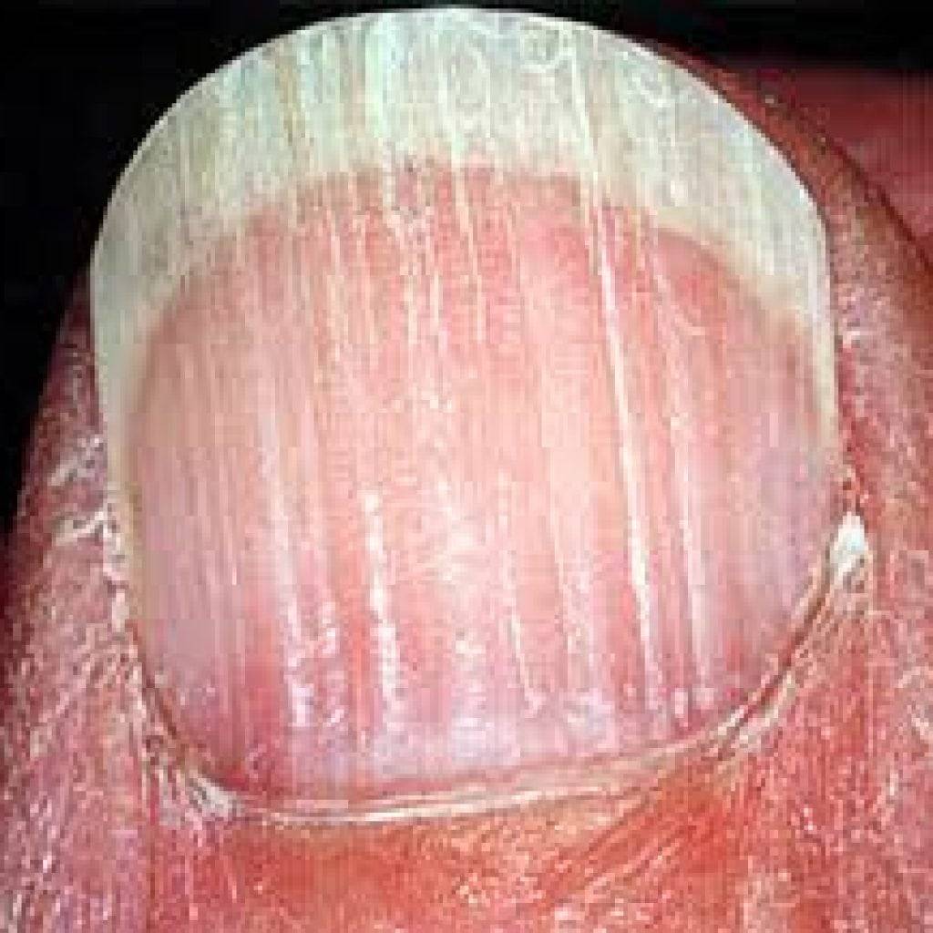 Белая полоска на ногте большого пальца ноги. почему появляются белые полоски на ногтях: лечение. причины появления белых отметин на ногтях