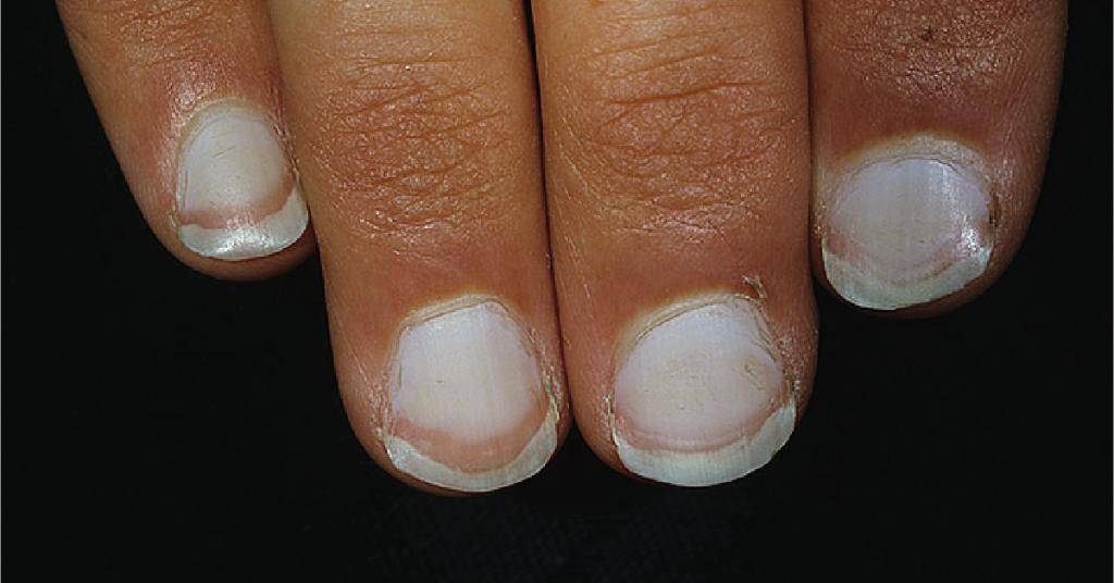 Болезни ногтей: причины, симптомы и лечение