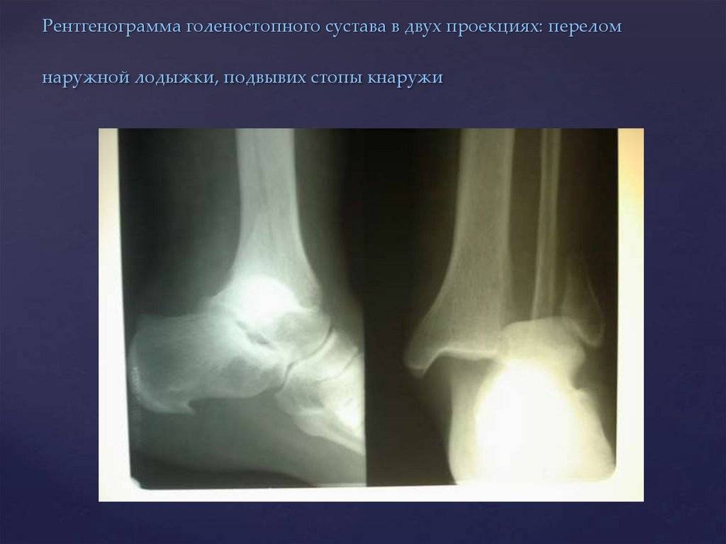 Рентген суставов детям и взрослым: что показывает, подготовка, как часто можно делать, рентгенография в 2 проекциях