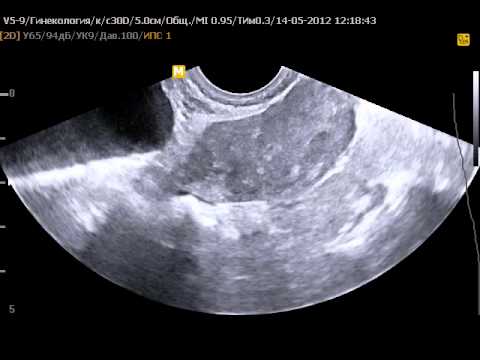 Что такое серометра матки — лечение серозометрия