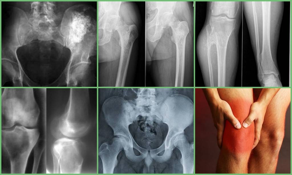 Рак кости ноги. Хондросаркома левой бедренной кости рентген. Саркома Юинга бедренной кости. Остеосаркома тазобедренного сустава кт. Саркома кости тазобедренного сустава.