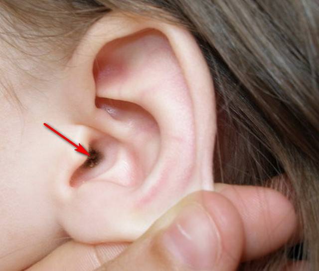 Причины и лечение шелушения, перхоти и сухости в ушах