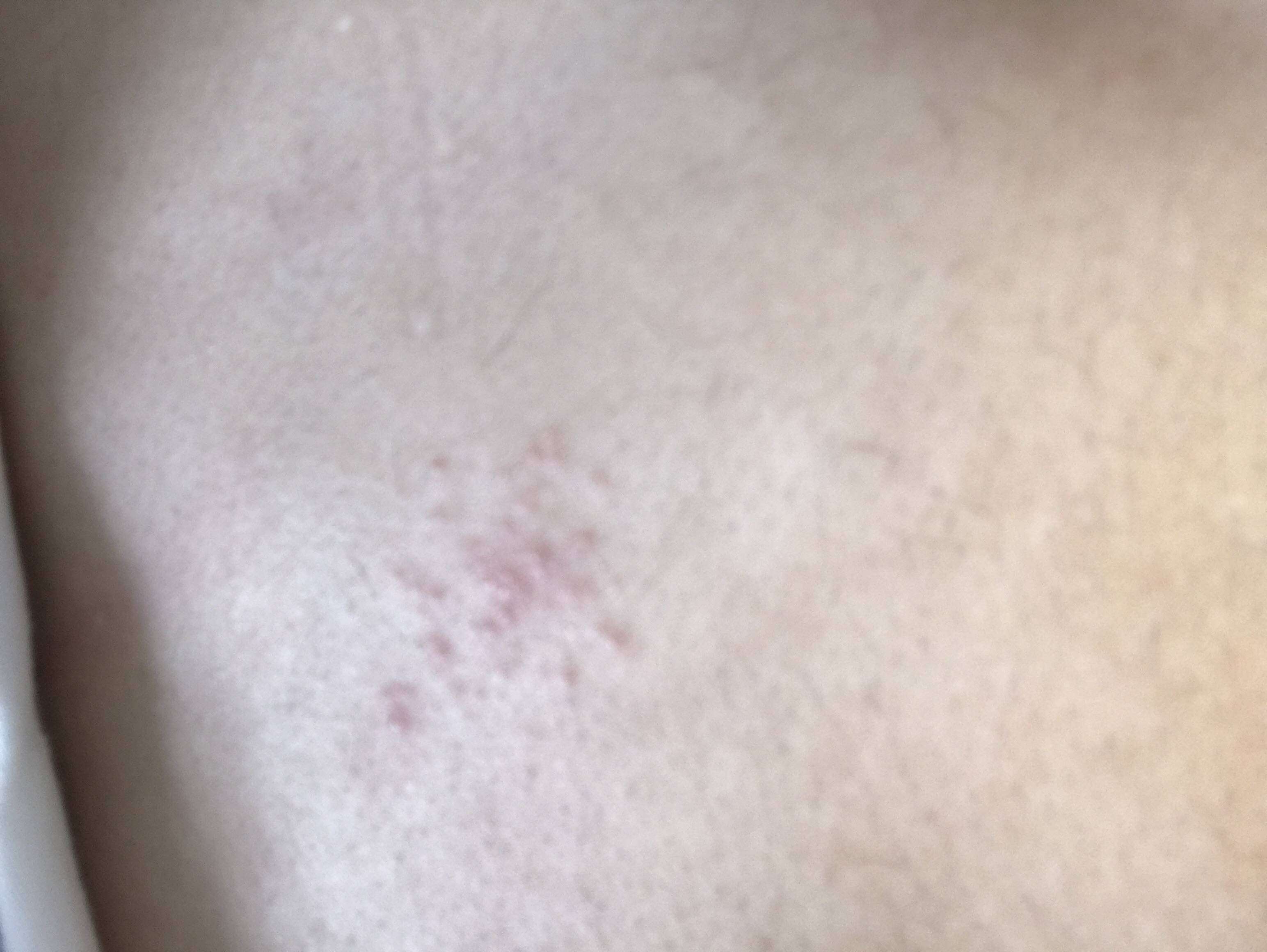Прыщи на теле – о чем говорят высыпания на разных участках кожи?