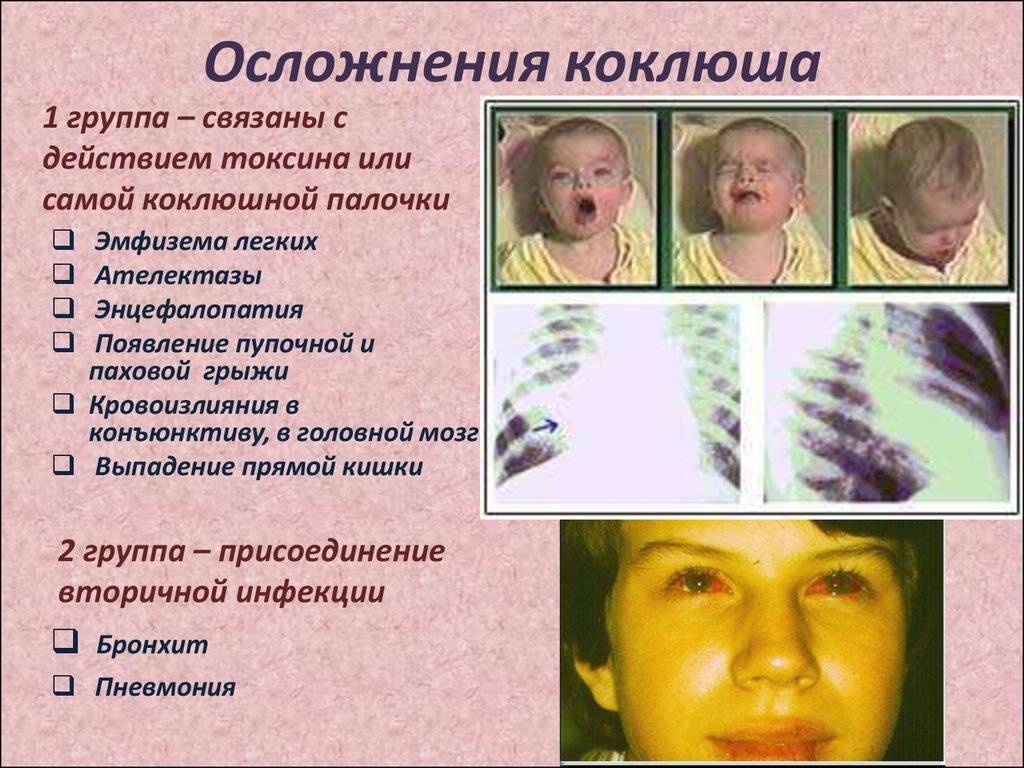 Паракоклюш у детей - симптомы, лечение, анализ на паракоклюш