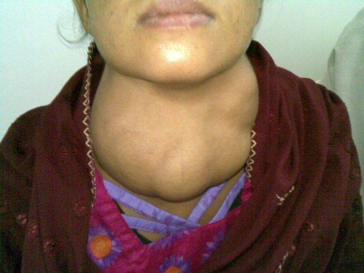 Первые симптомы проблемы с щитовидной железой у женщин
