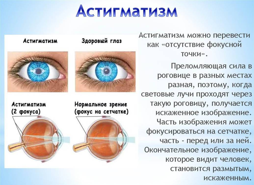 Миопический астигматизм: методы лечения - "здоровое око"