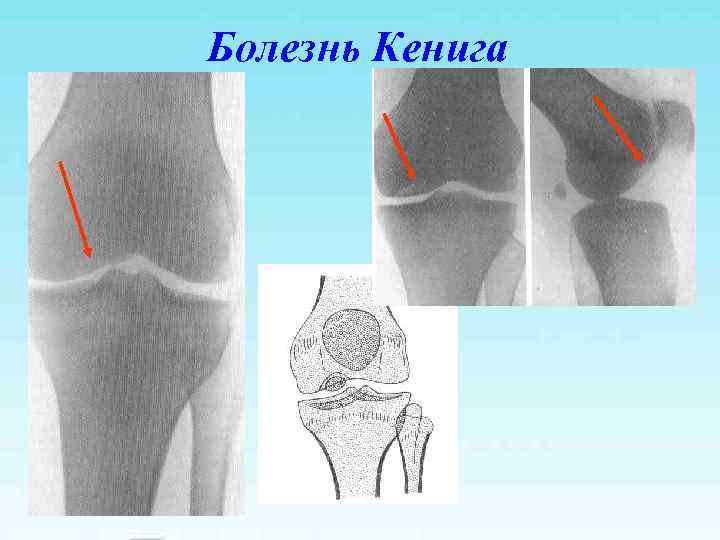 Болезнь кенига коленного сустава. что это такое, лечение, стадии у детей, спортсменов, взрослых, операция — medists.ru