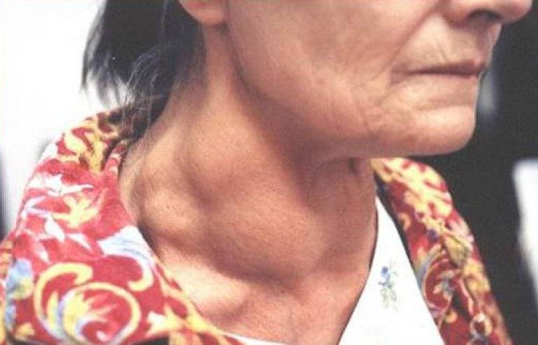 Щитовидная железа: симптомы заболевания у женщин, лечение, причины