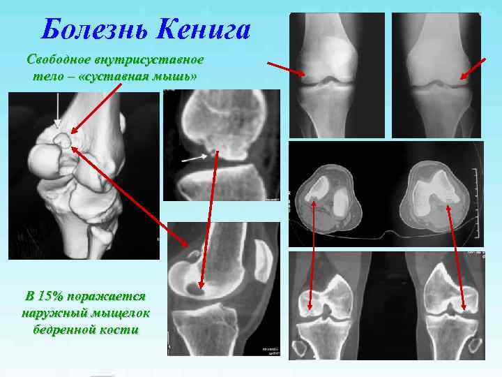 Болезнь кенига коленного сустава у детей | лечение суставов