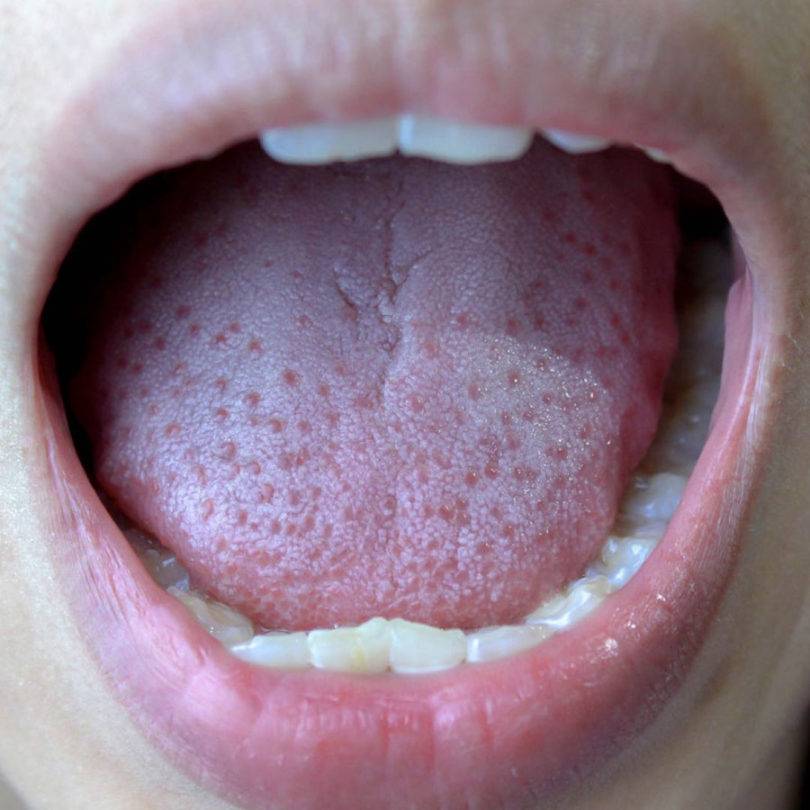 Болит ли горло при коронавирусе у человека, как выглядит? першение в горле при коронавирусе