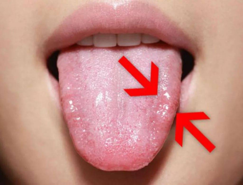 Сухость во рту и жжение языка: причины и подходы к лечению неприятного ощущения