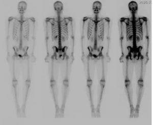 Что такое сцинтиграфия костей скелета