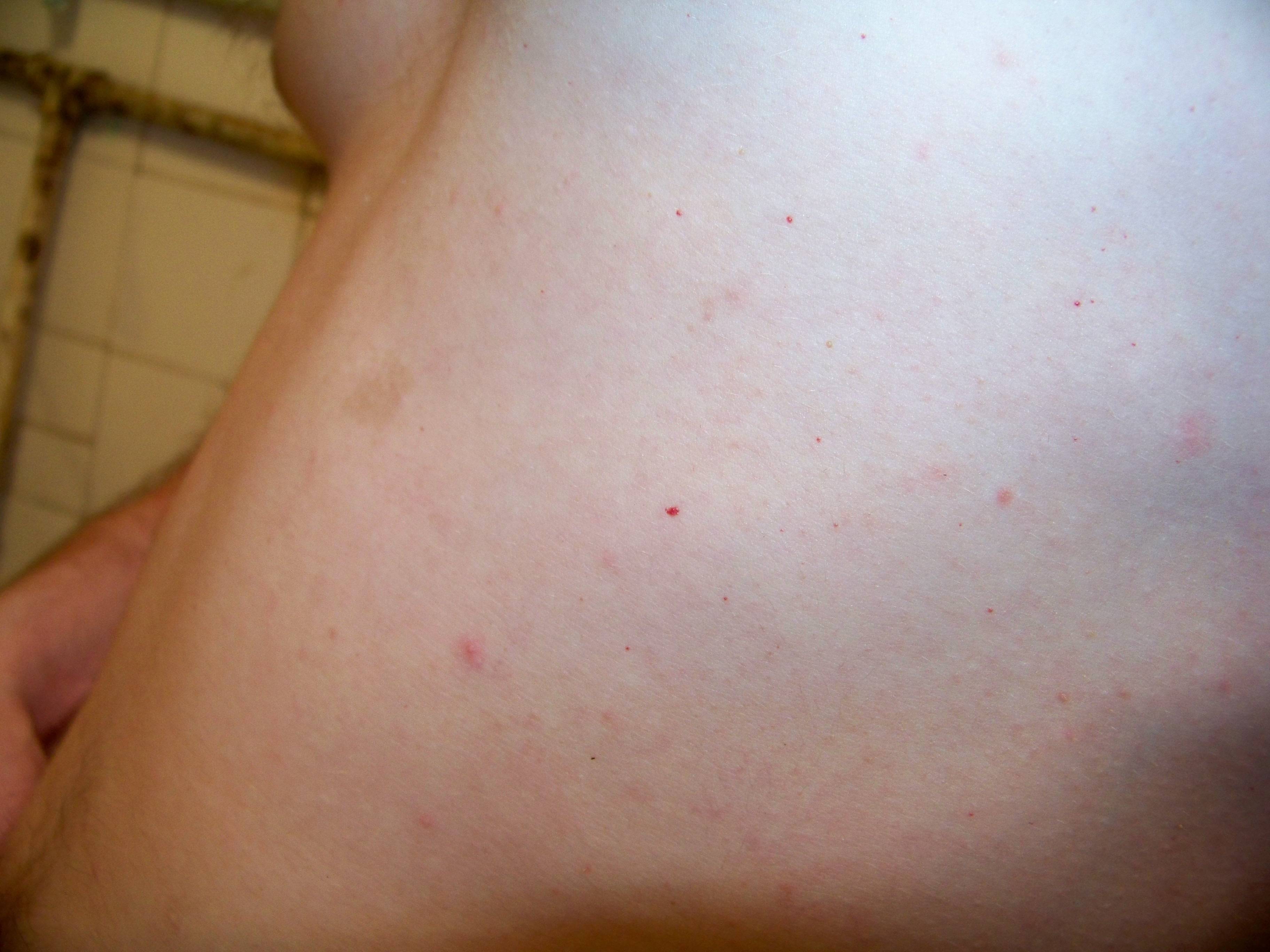 высыпания на коже груди у женщин фото 44