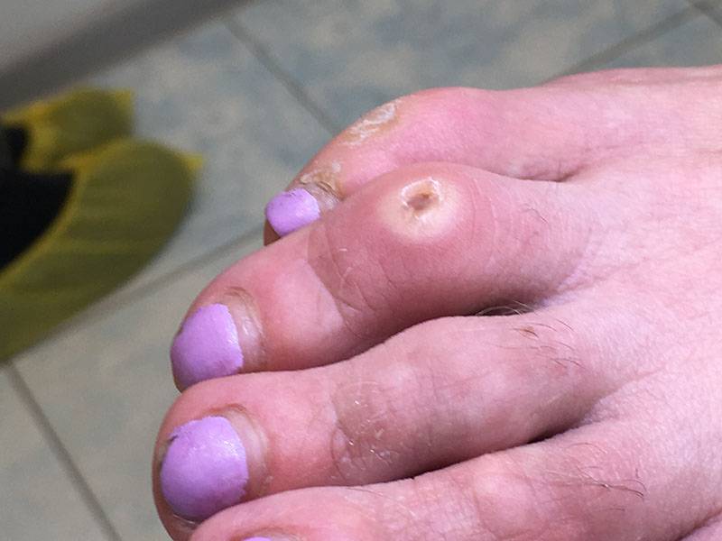 Сухая мозоль на пальце ноги: лечение + фото, как избавиться от натоптыша специальными средствами, если он воспалился и чем вывести в домашних условиях?