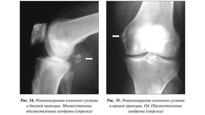 Болезнь кенига коленного сустава операция | лечение суставов
