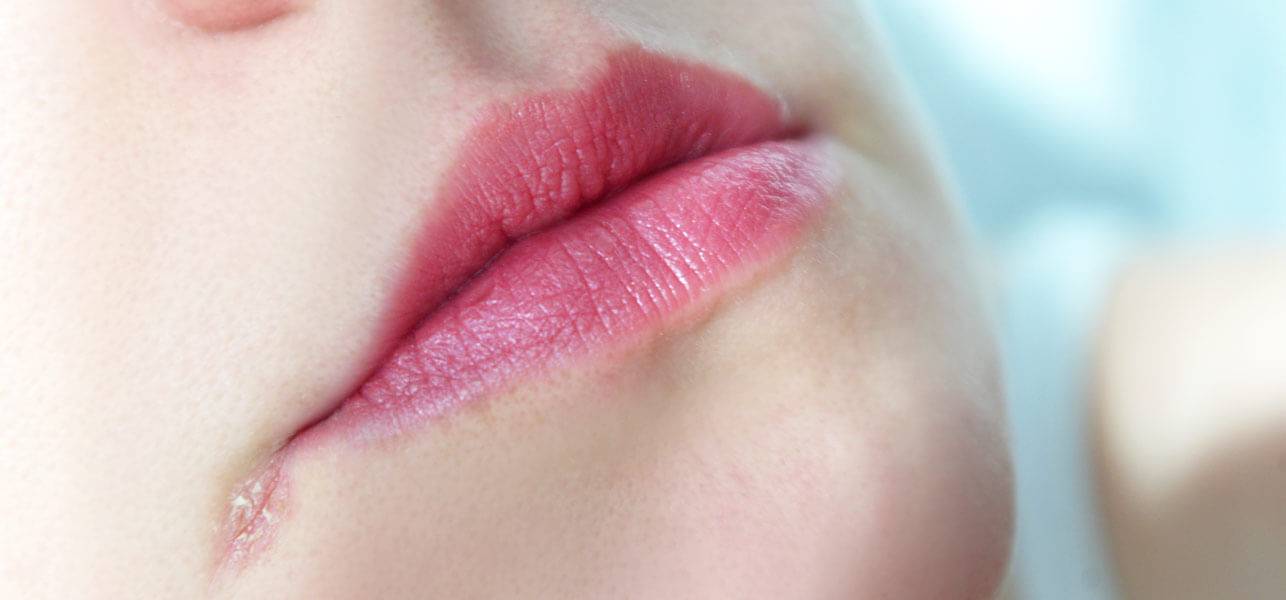 Чем лечить уголки губ быстро: как убрать заеды, трещины и болячки