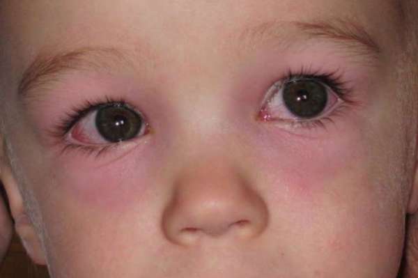 Как лечить аллергию на глазах: причины, симптомы, лучшие лекарственные препараты и народные средства, эффективные способы и рекомендации