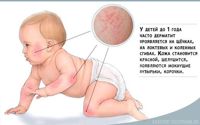 Пеленочный дерматит: лечение и симптомы заболевания у грудничков и новорожденных по комаровскому